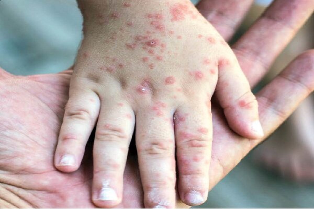 زنگ خطر بازگشت یک بیماری در کشورهای اروپایی