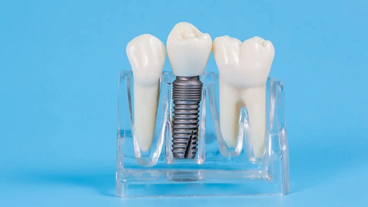 بررسی اجمالی انواع خدمات ایمپلنت دندان و مقایسه قیمت‌های آن
